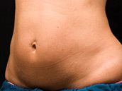 Procedimiento CoolSculpting Antes