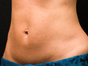 Procedimiento CoolSculpting después