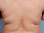 Procedimiento CoolSculpting Antes