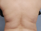 Procedimiento CoolSculpting después