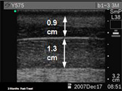 Procedimiento CoolSculpting Después